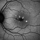Stargardts Disease in FAF Stargardts Disease in FAF
